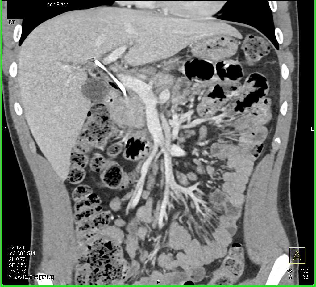 Subtle Pancreatic Cancer with Common Bile Duct (CBD) Stent - CTisus CT Scan