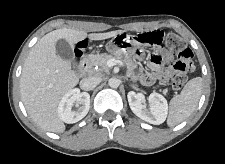 Subtle Pancreatic Cancer with Common Bile Duct (CBD) Stent - CTisus CT Scan