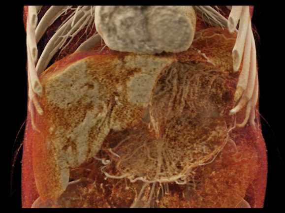 Gastic Varices and Liver Disease - CTisus CT Scan