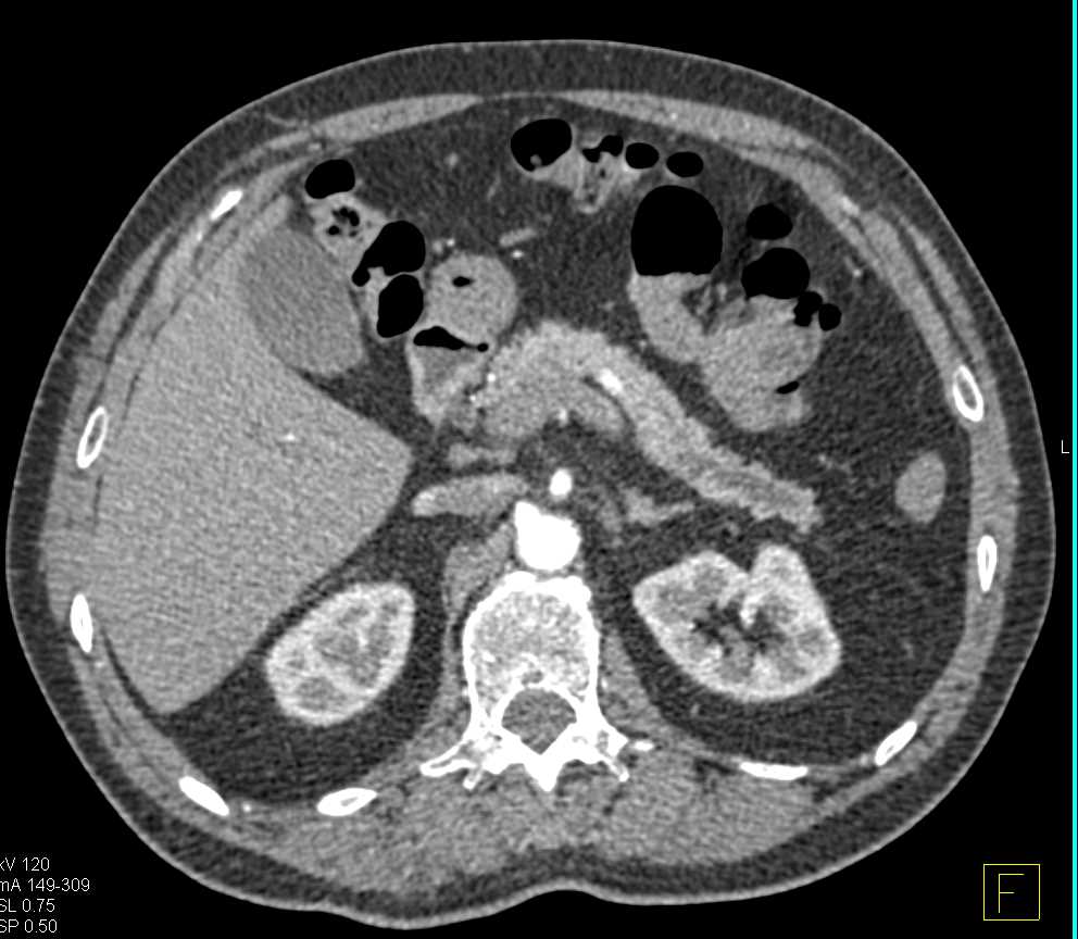 Subtle Pancreatic Cancer - CTisus CT Scan