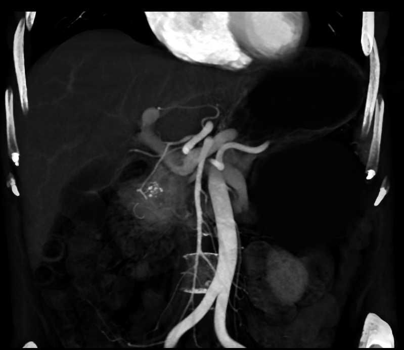 Neuroendocrine Tumor Head of Pancreas - CTisus CT Scan