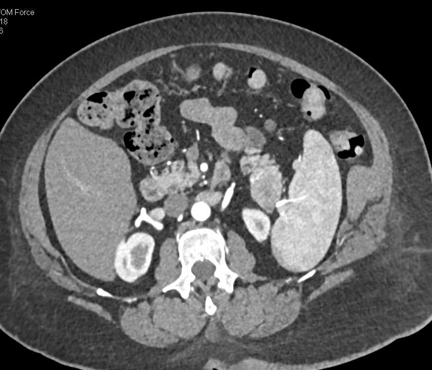 Neuroendocrine Tumor Tail of Pancreas - CTisus CT Scan