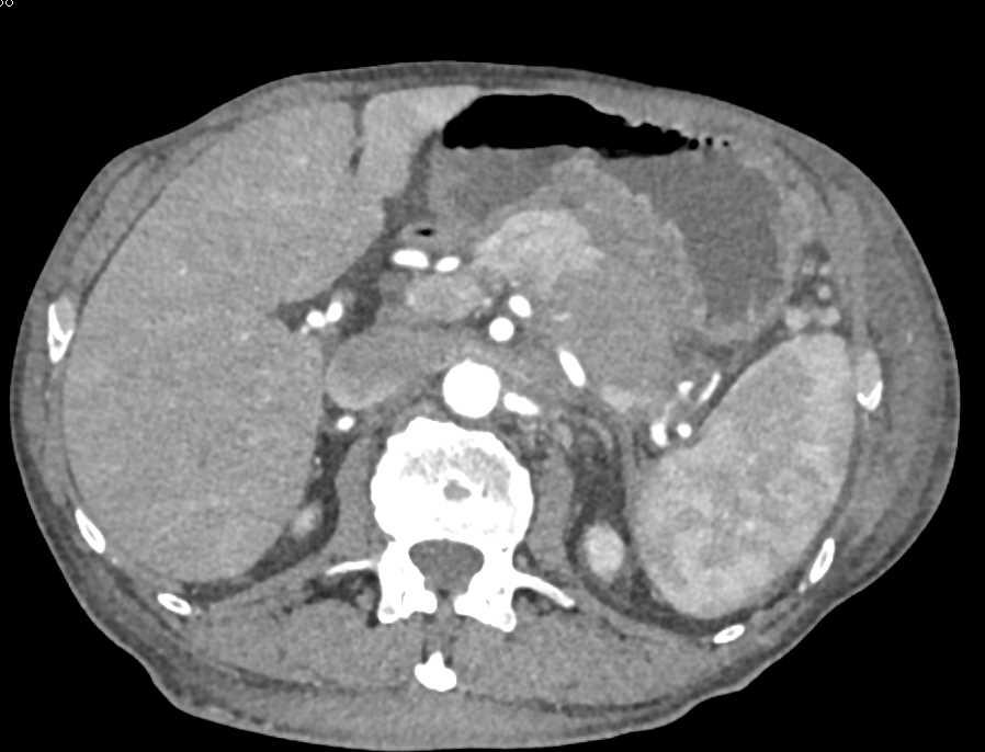 Carcinoma Tail of Pancreas - CTisus CT Scan