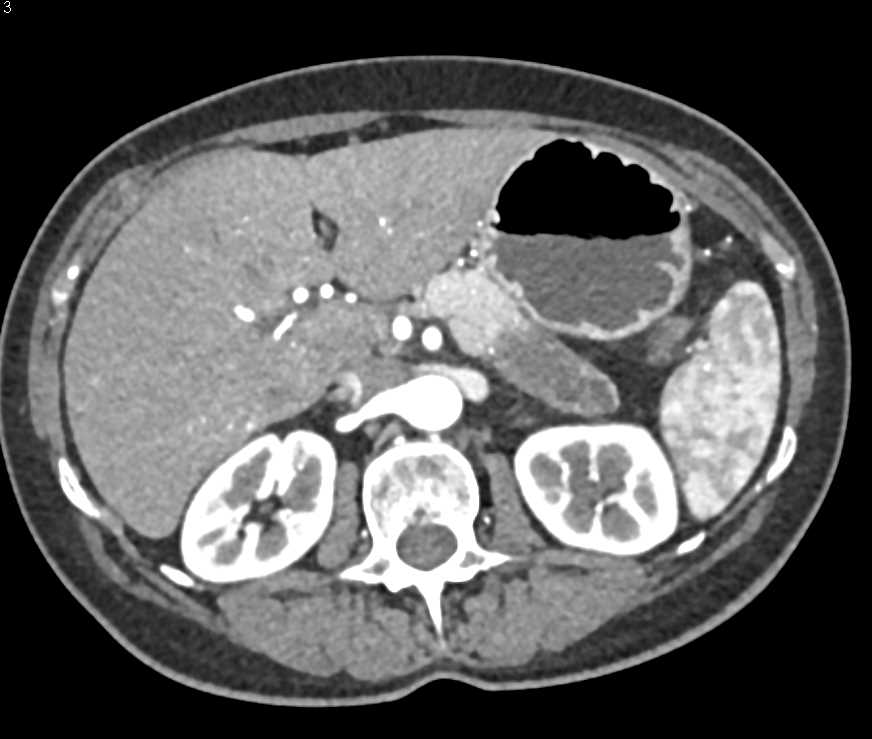 Carcinoma Tail of Pancreas - CTisus CT Scan