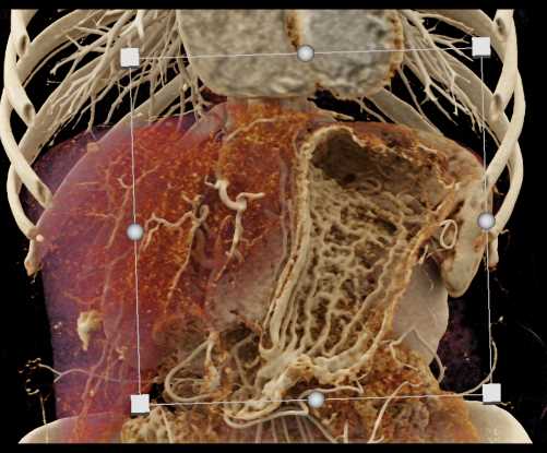 Carcinoma Tail of Pancreas - CTisus CT Scan