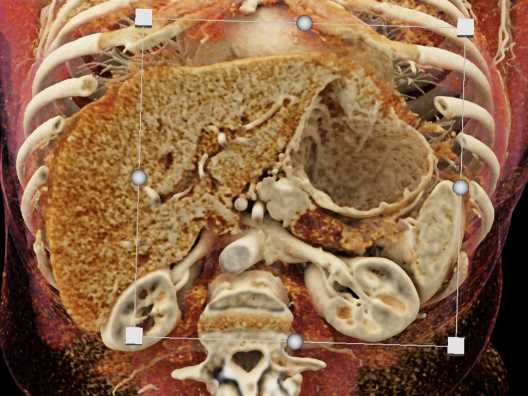 Carcinoma Tail of Pancreas - CTisus CT Scan