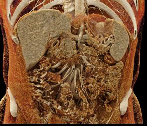 Pancreatic Cancer Encases the Superior Mesenteric Vein (SMV) - CTisus CT Scan