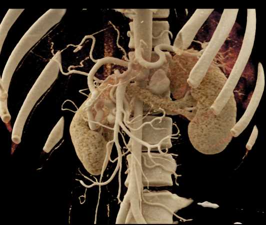 Neuroendocrine Tumor Tail of the Pancreas - CTisus CT Scan