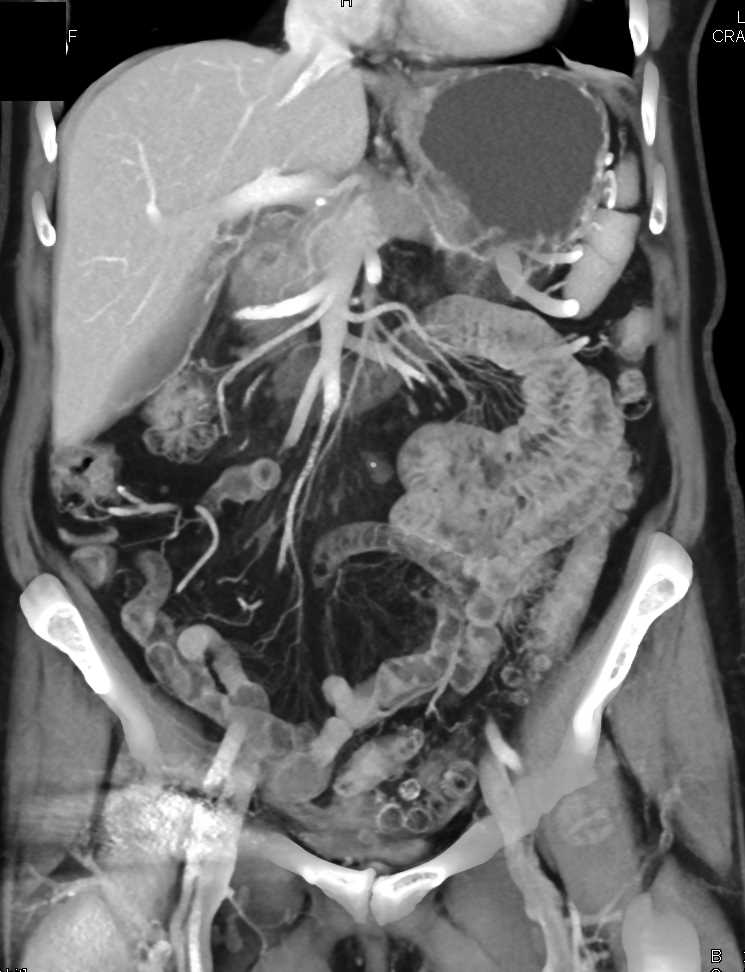 Adenocarcinoma Tail of Pancreas with Vascular Encasement - CTisus CT Scan