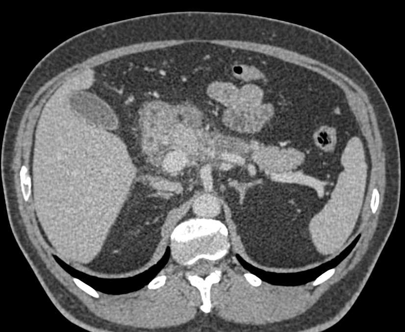 Autoimmune Pancreatitis (AIP) - CTisus CT Scan