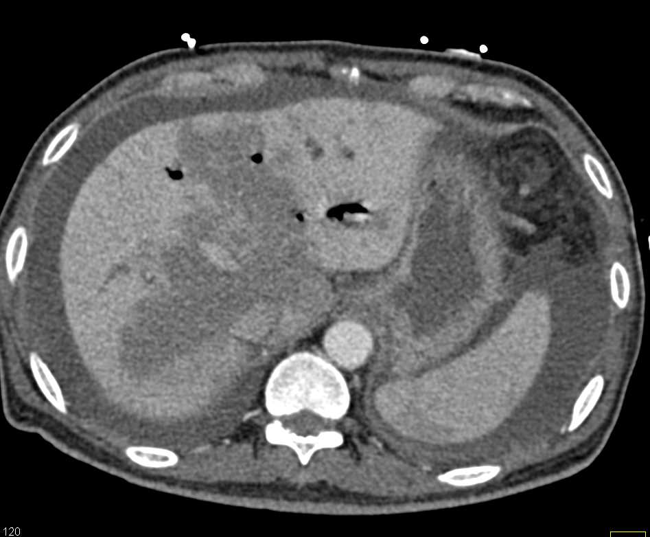 Pancreatic Cancer Extends into the Hilum of the Liver - CTisus CT Scan