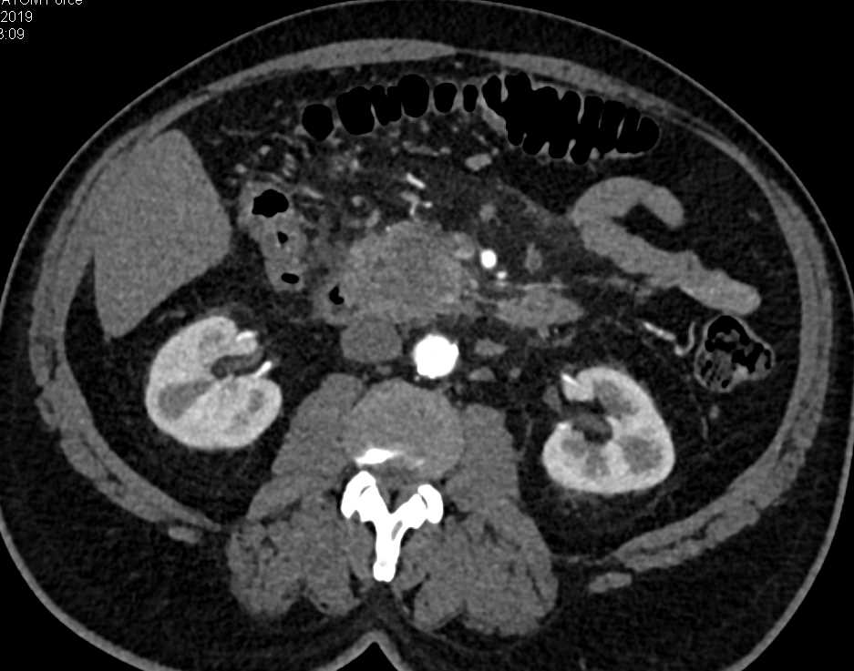 Pancreas Adenocarcinoma - CTisus CT Scan