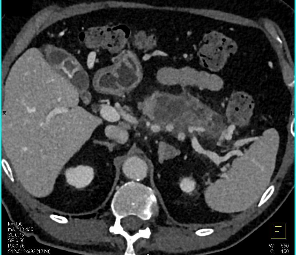 CTisus CT Scanning | Carcinoma Tail of Pancreas