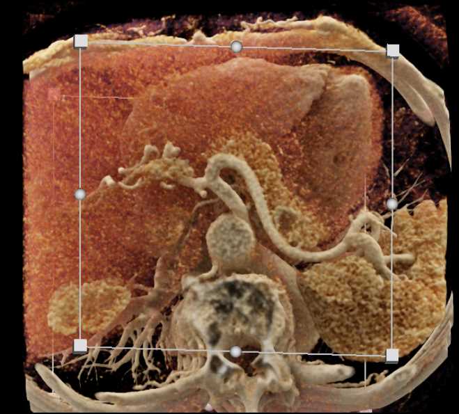 1cm Pancreatic Lesion in the Tail of the Pancreas - CTisus CT Scan