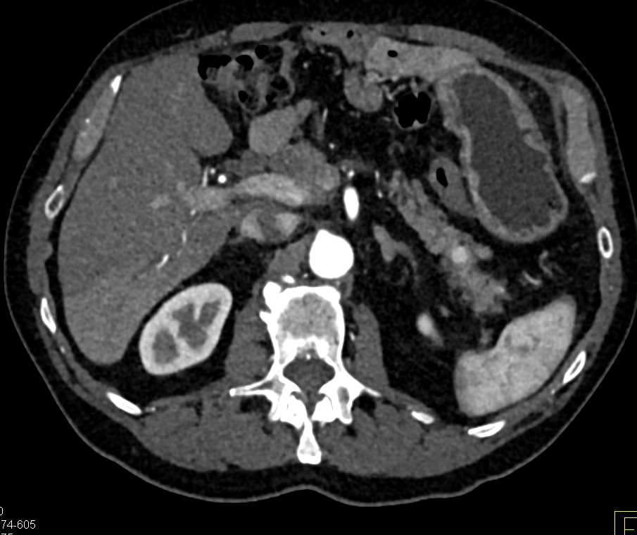 Pancreatic Neuroendocrine Tumor (PNET) Tail of Pancreas - CTisus CT Scan