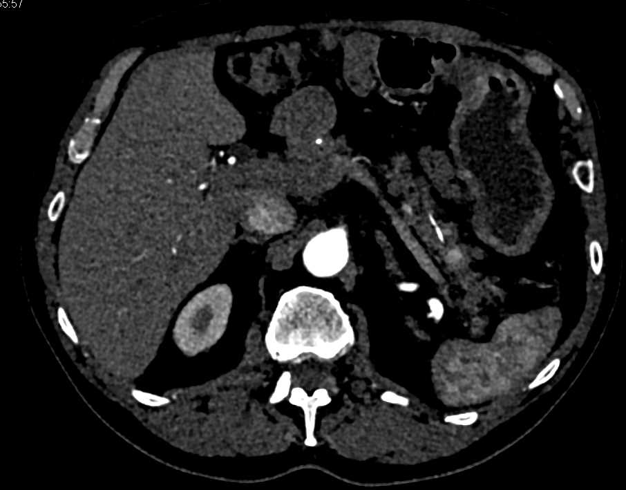 Contrast in the Pancreatic Duct - CTisus CT Scan