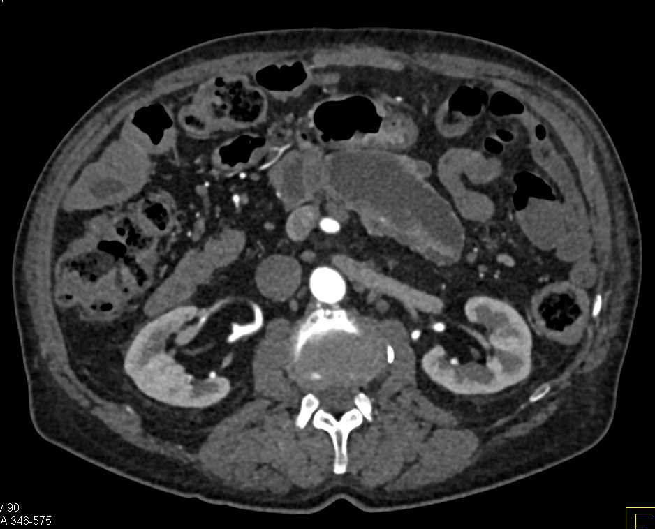 Main Duct Intraductal Papillary Mucinous Neoplasm (IPMN) with Adenocarcinoma - CTisus CT Scan