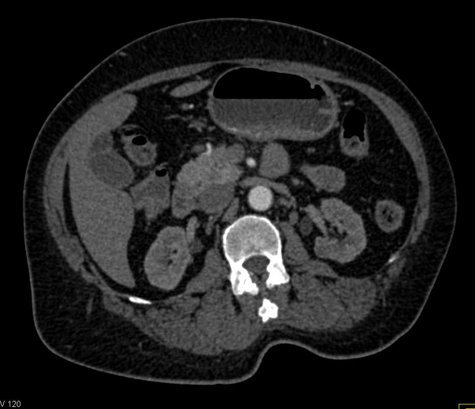 Subtle 1cm Pancreatic Neuroendocrine Tumor (PNET) in the Head of the Pancreas - CTisus CT Scan