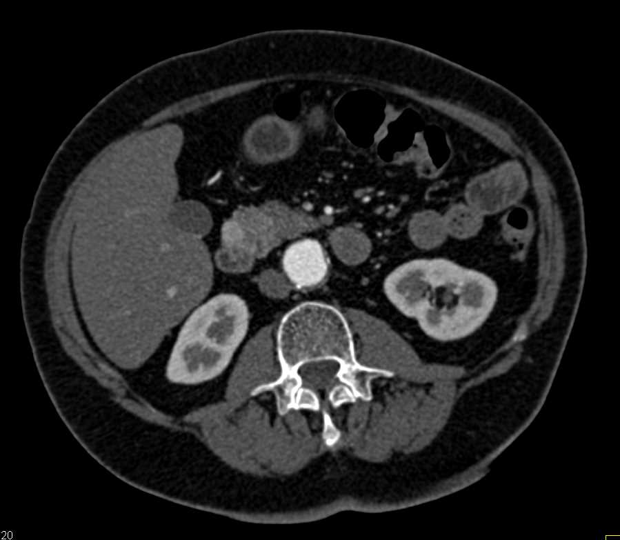 Pancreatic Neuroendocrine Tumor (PNET) Head of Pancreas - CTisus CT Scan