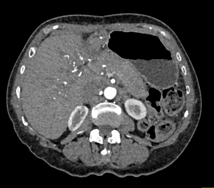 Ig4  Disease Involves the Pancreas and the Kidneys - CTisus CT Scan