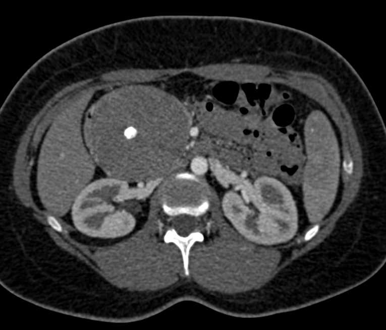 Solid and Papillary Epithelial Neoplasm (SPEN) Tumor looks like a Serous Cystadenoma Based on the Central Calcification - CTisus CT Scan