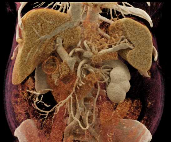 Carcinoma Head of Pancreas - CTisus CT Scan