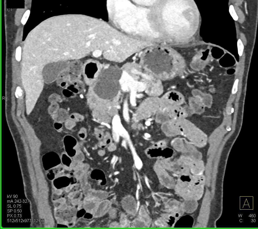 Intraductal Papillary Mucinous Neoplasm (IPMN) Head of Pancreas - CTisus CT Scan