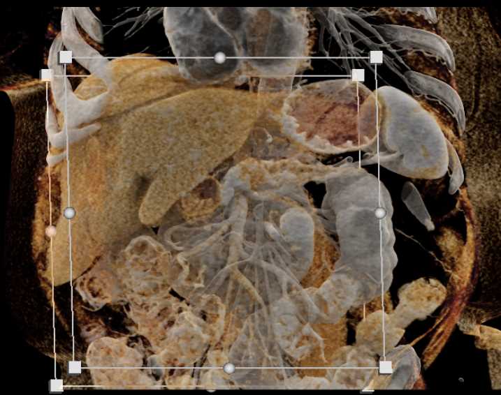 Pancreatic Cancer Obstructs the Pancreatic Duct - CTisus CT Scan