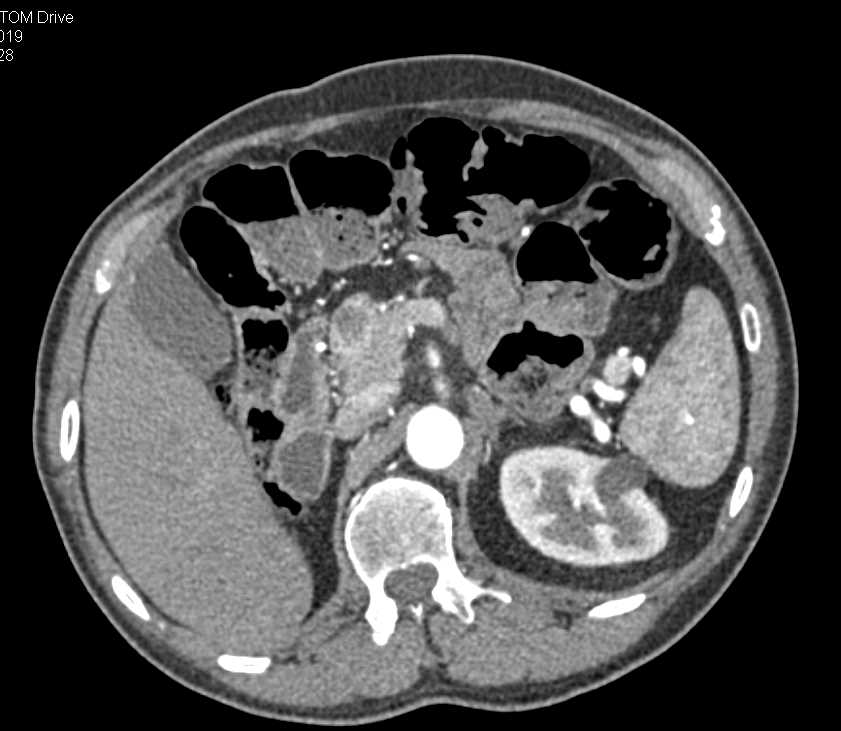 Carcinoma of the Pancreas - CTisus CT Scan