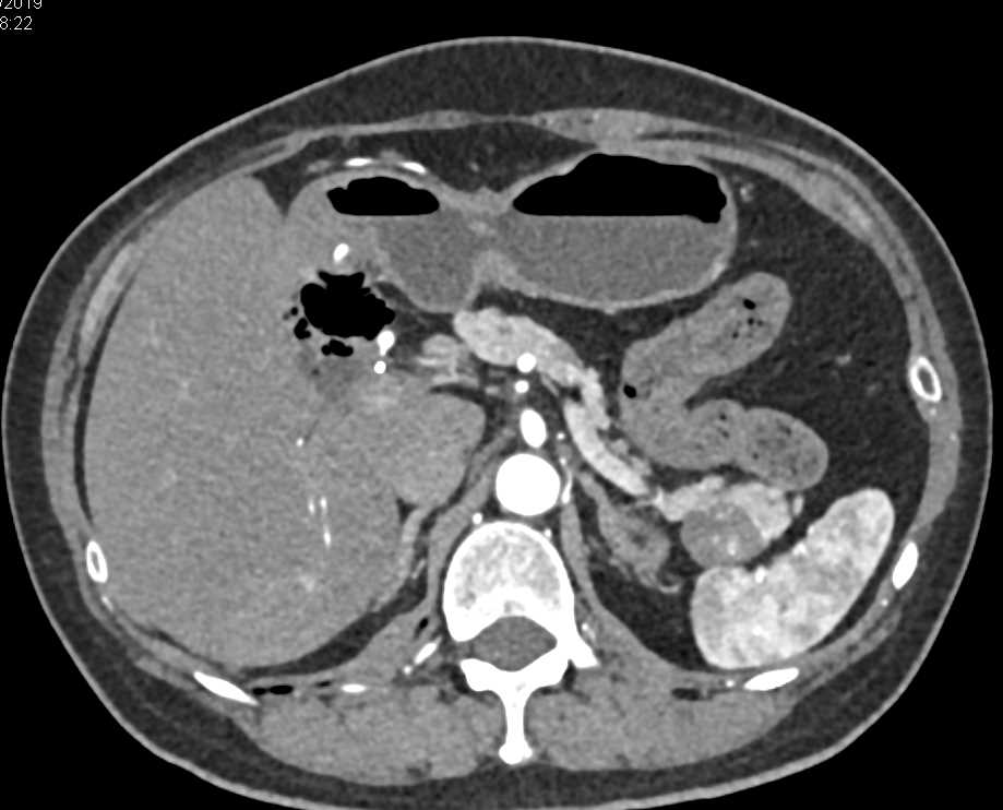 Solid and Papillary Epithelial Neoplasm (SPEN) Tumor - CTisus CT Scan