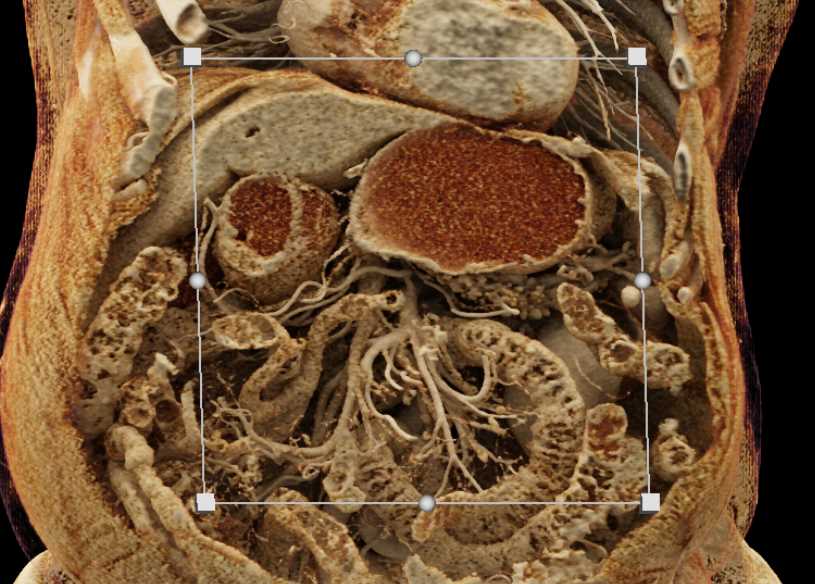 Pancreatic Neuroendocrine Tumor (PNET) in Head of Pancreas - CTisus CT Scan