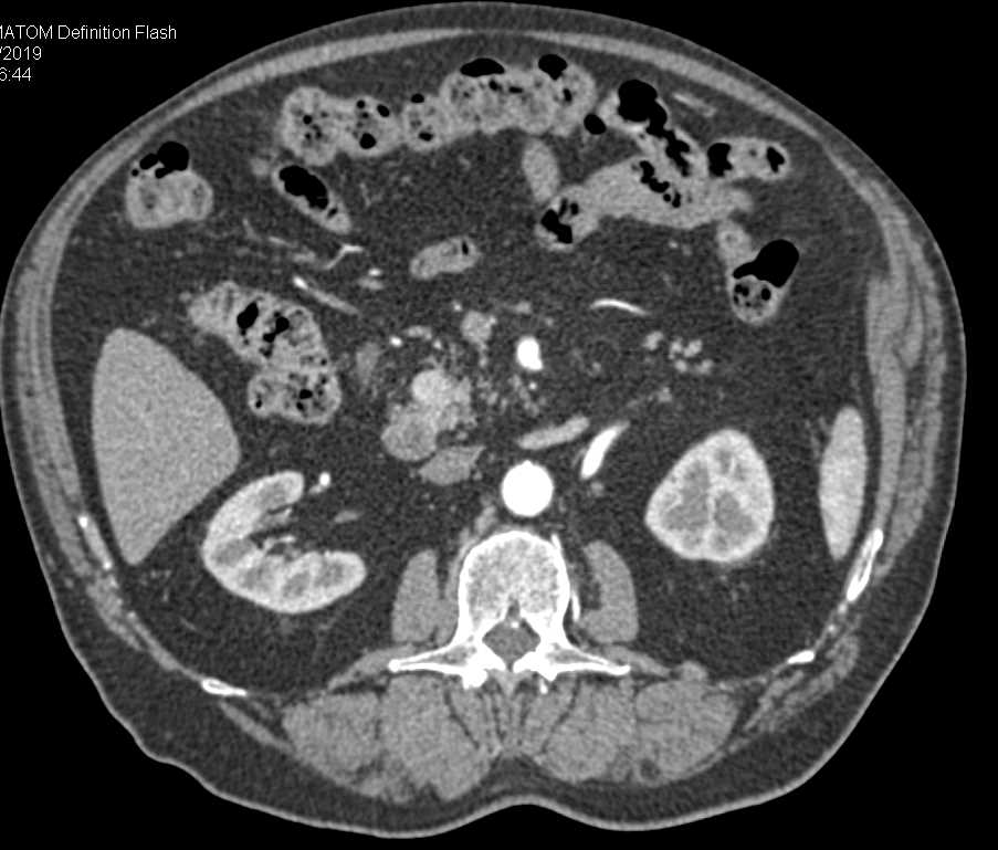 Pancreatic Neuroendocrine Tumor (PNET) in Head of Pancreas - CTisus CT Scan