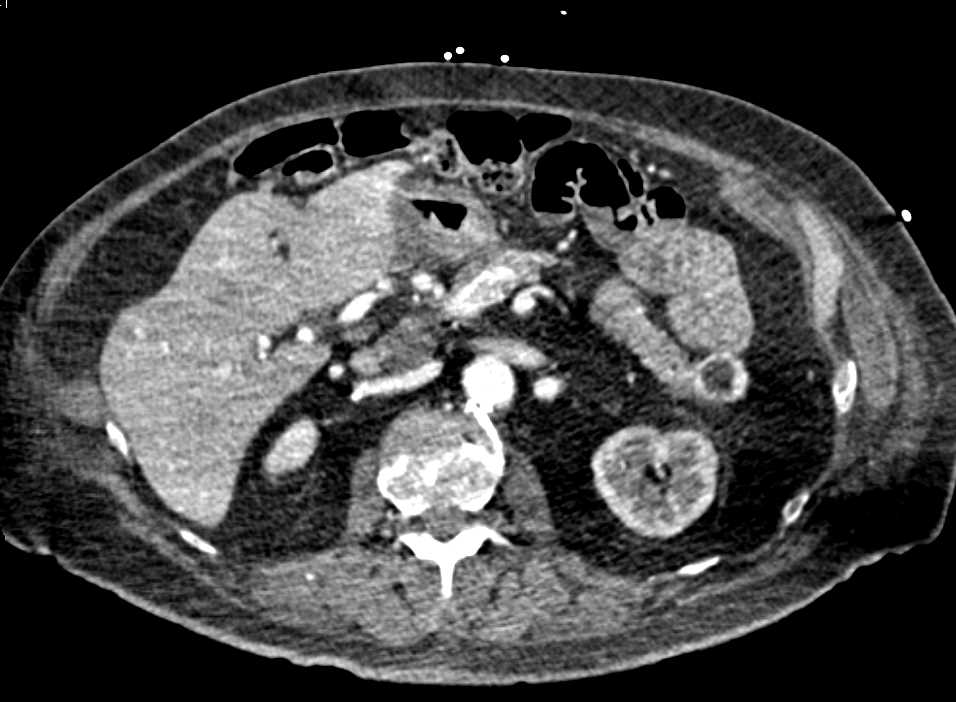 Pancreatic Neuroendocrine Tumor (PNET) Tail of Pancreas - CTisus CT Scan