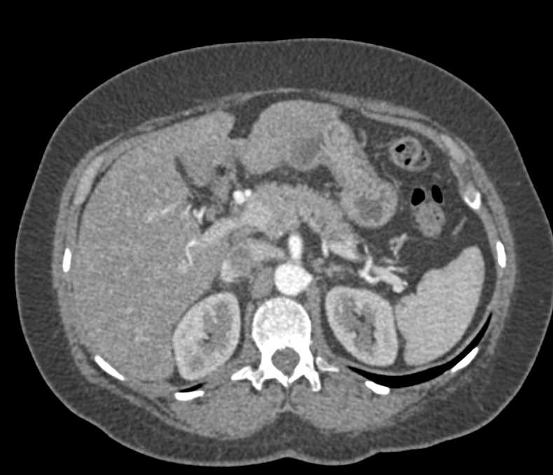 Pancreatic Adenocarcinoma - CTisus CT Scan