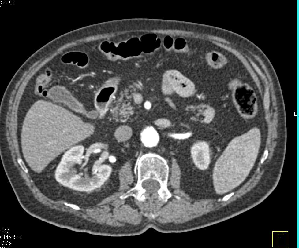 Pancreatic Neuroendocrine Tumor (PNET) Tail of Pancreas - CTisus CT Scan