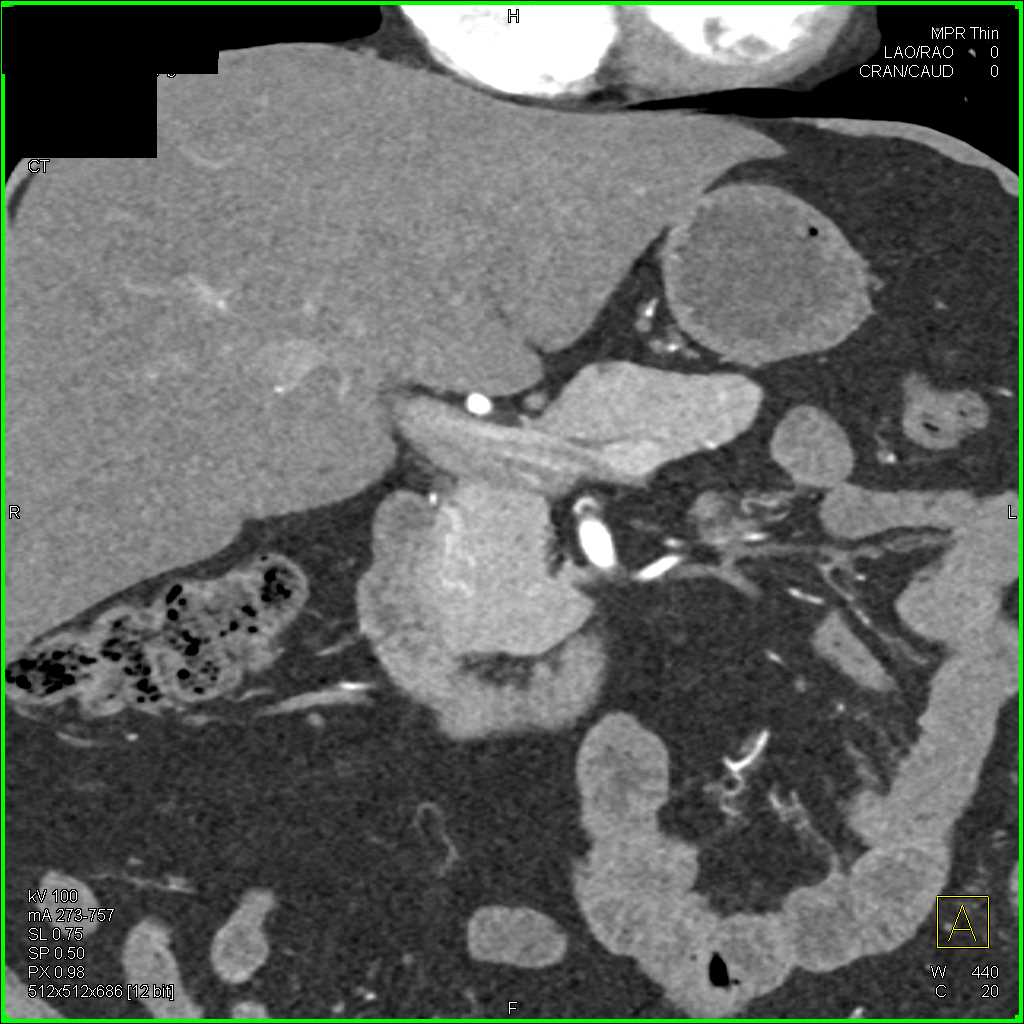 Subtle Neuroendocrine Tumor Head of Pancreas - CTisus CT Scan