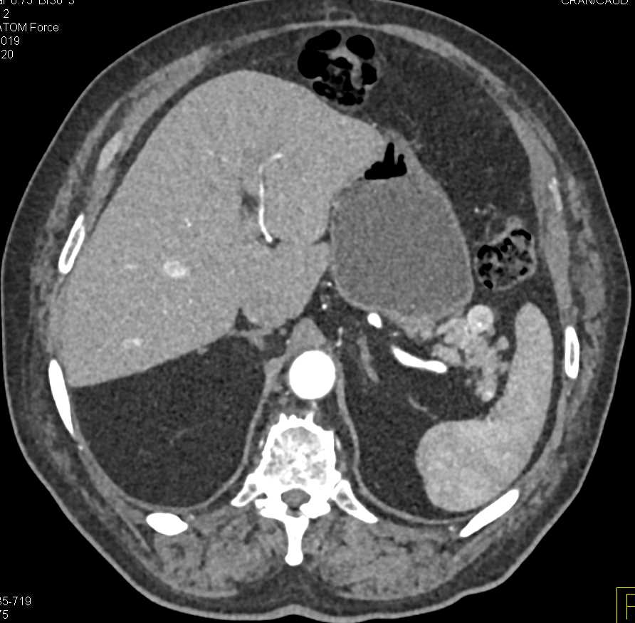 Neuroendocrine Tumor Tail of Pancreas - CTisus CT Scan