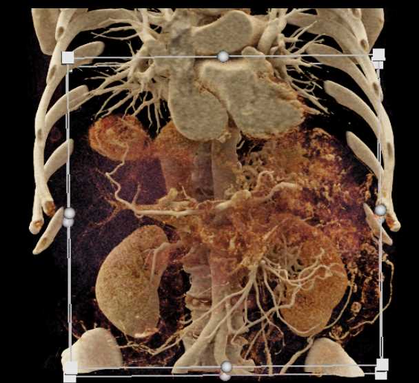 Neuroendocrine Tumor of the Pancreas - CTisus CT Scan