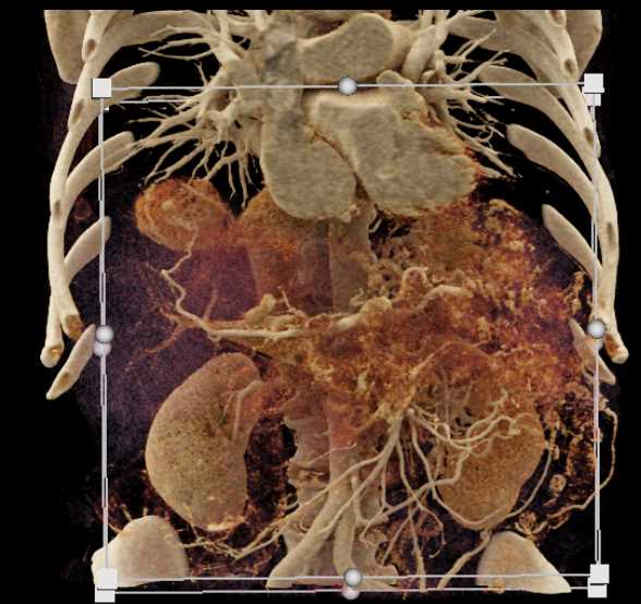 Neuroendocrine Tumor of the Pancreas with Liver Metastasis - CTisus CT Scan