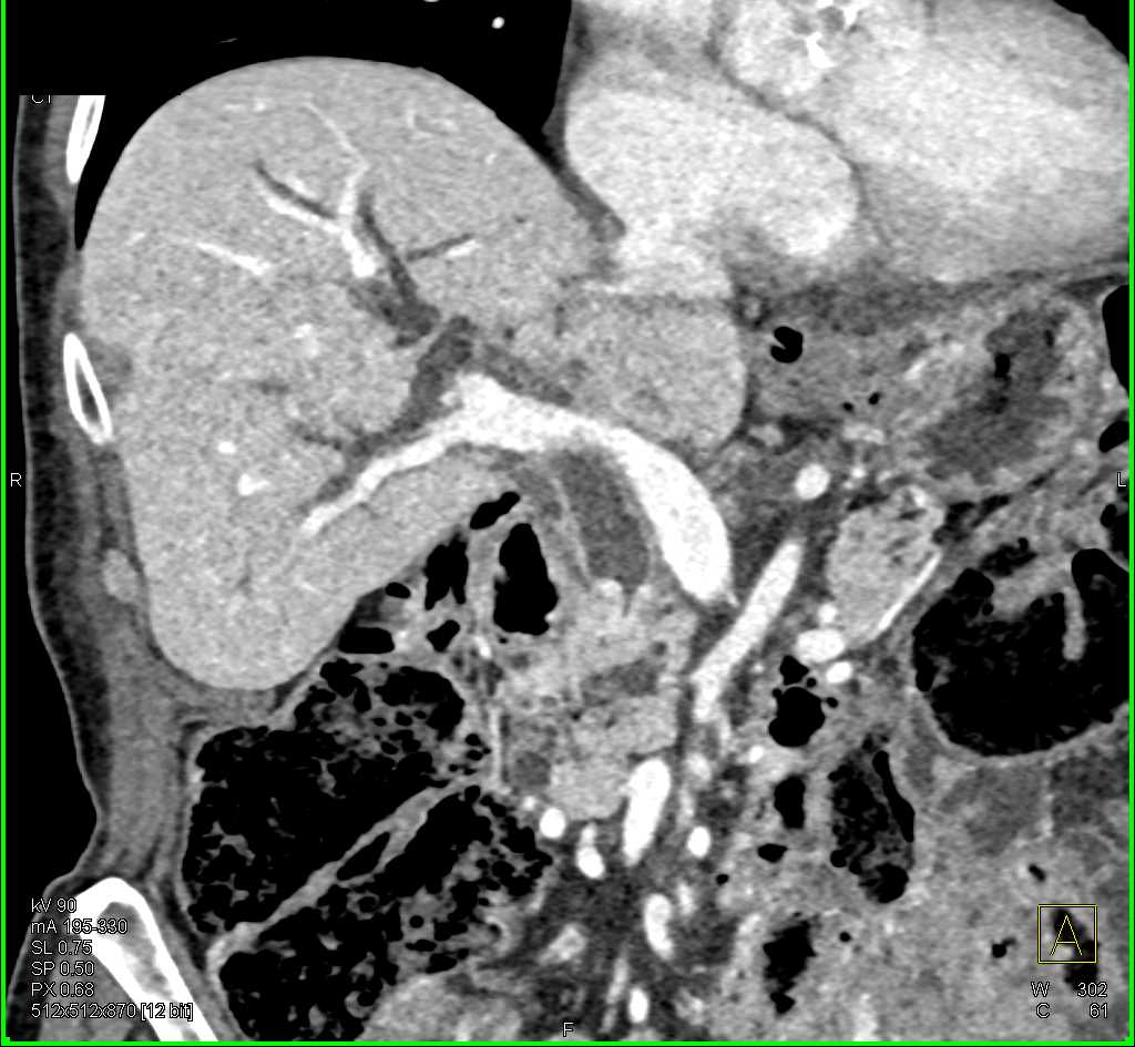 Ampullary Carcinoma - CTisus CT Scan