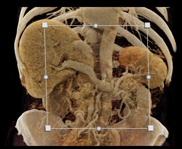 Pancreatic Cancer - CTisus CT Scan