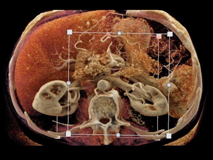 Small Pancreatic Cancer with Vascular Map - CTisus CT Scan