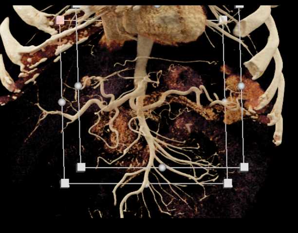 Small Pancreatic Cancer with Vascular Map - CTisus CT Scan