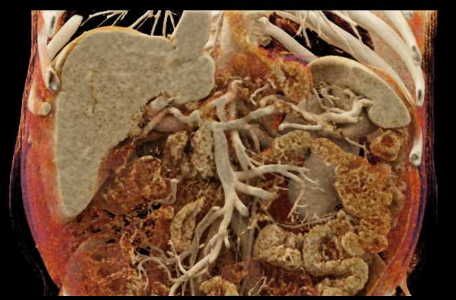 Small Pancreatic Cancer with Vascular Map - CTisus CT Scan