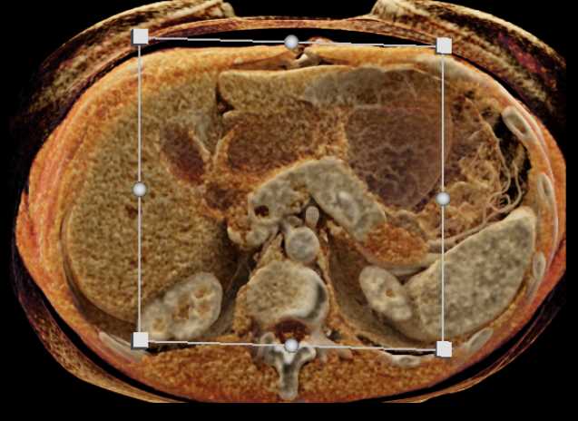 Adenocarcinoma Tail of Pancreas - CTisus CT Scan