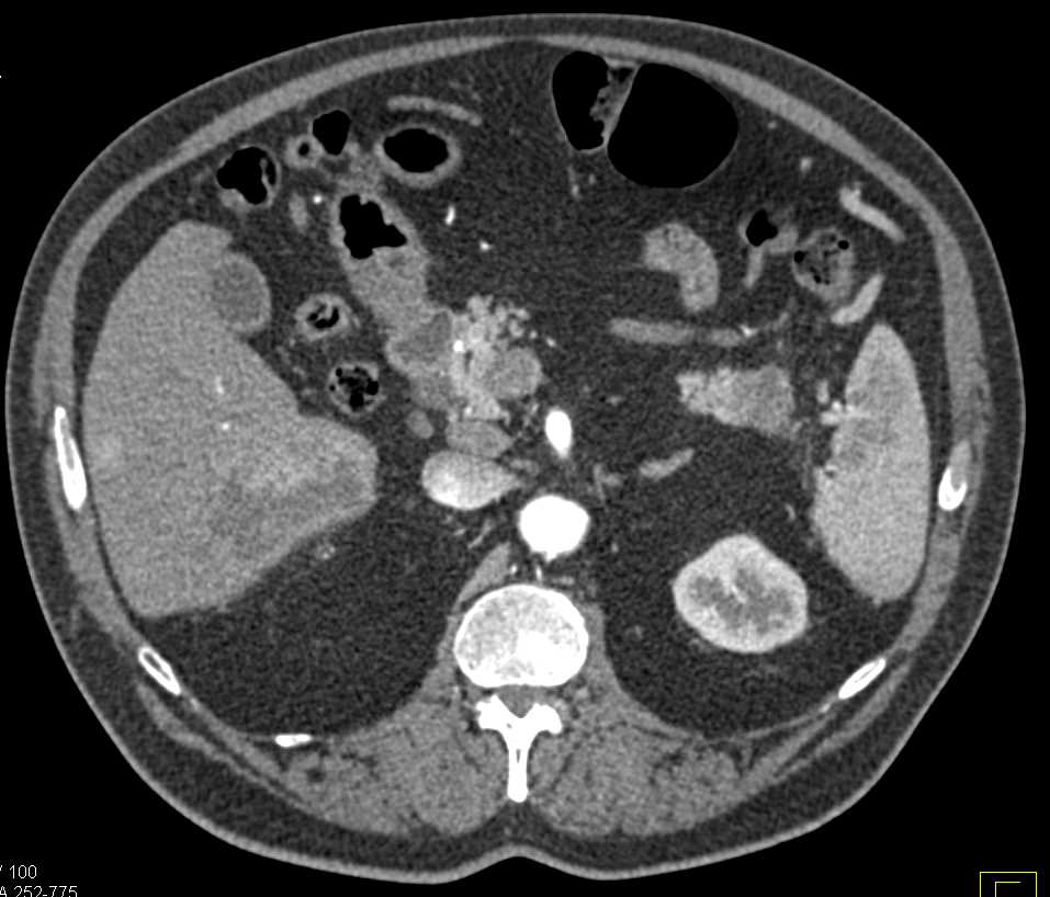 Subtle Pancreatic Carcinoma with Liver Metastases - CTisus CT Scan