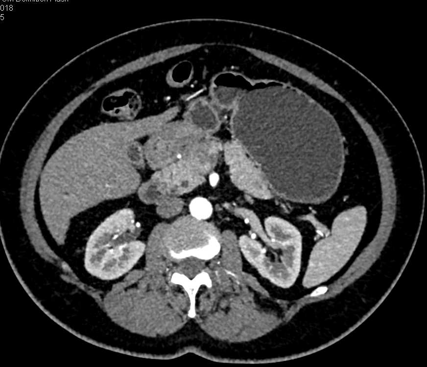 Pancreatic Adenocarcinoma - CTisus CT Scan