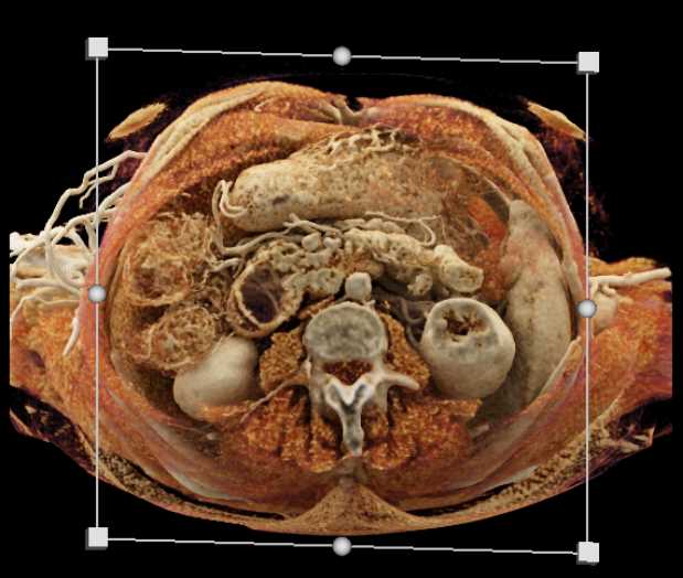 Subtle Pancreatic Cancer - CTisus CT Scan