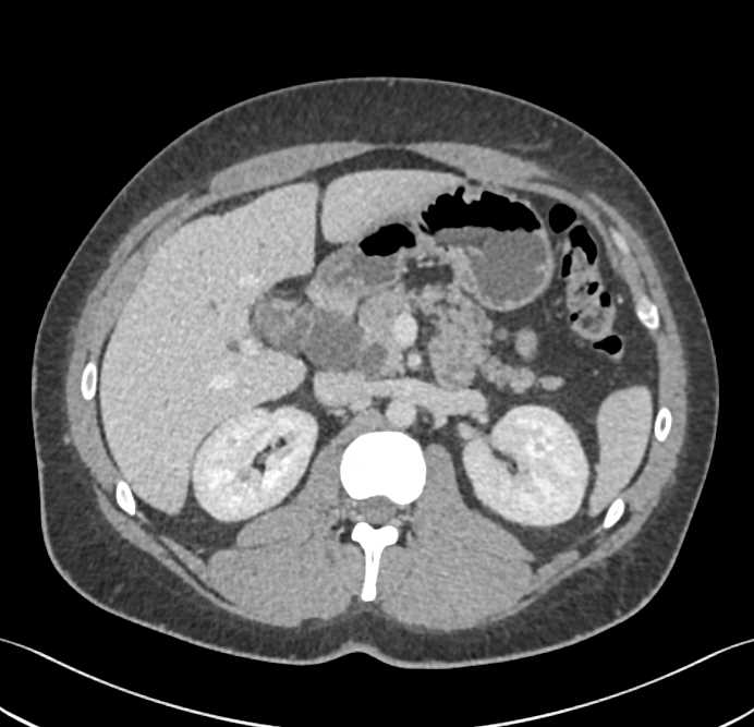 Subtle Pancreatic Cancer - CTisus CT Scan