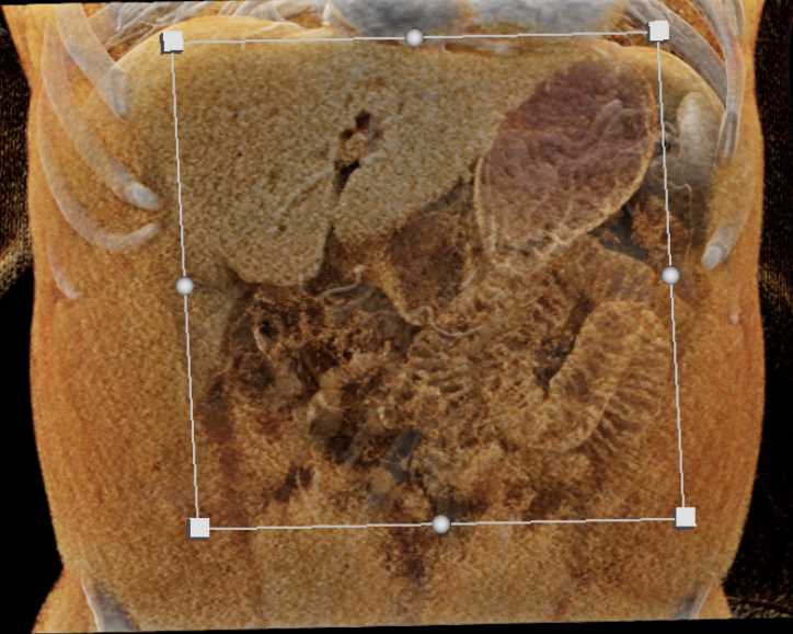 Subtle Pancreatic Cancer with Dilated Common Bile Duct (CBD) - CTisus CT Scan